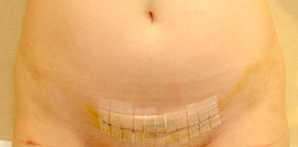hysterectomy scars pictures