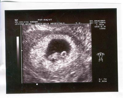 Scan at 8.5 weeks. Steve was sure, from that moment on, that the baby was 